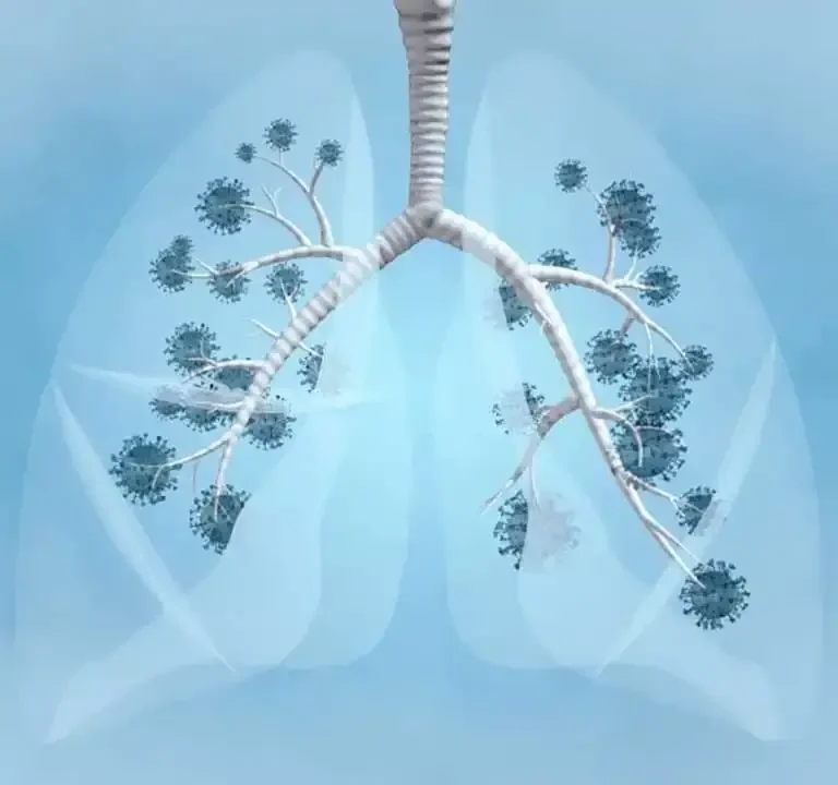 tuberculosis-1660823214